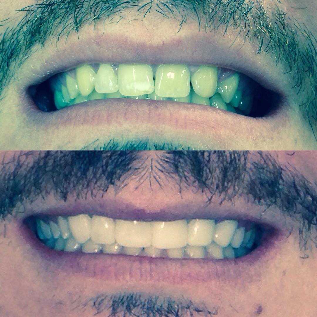 Restauração Estética — antes e depois